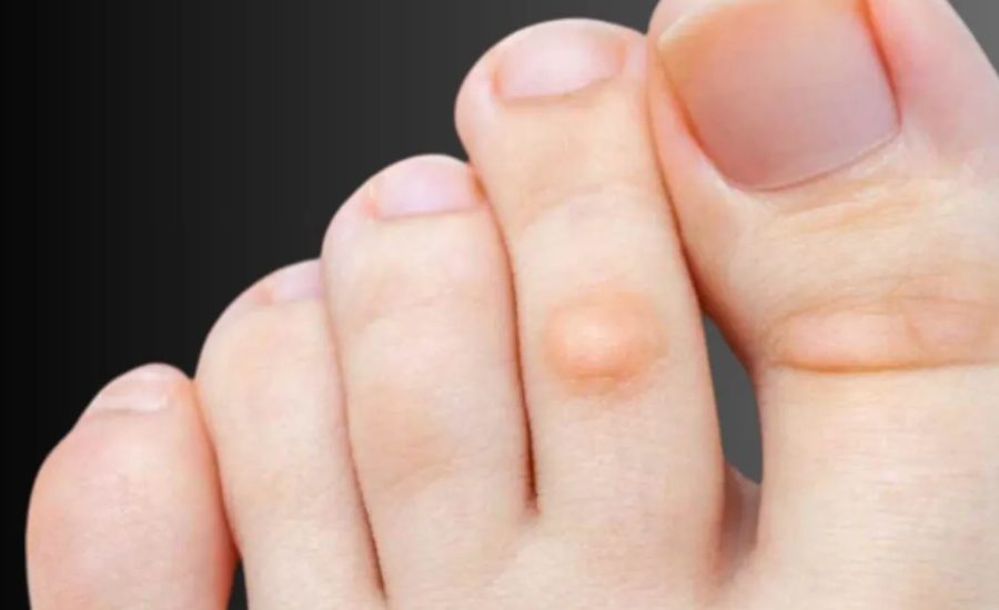 What Are Blisterata?